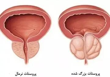 پروستات