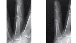 ماجرای مردی که از پزشکان خواست دو انگشتش را قطع کنند