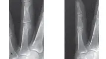 ماجرای مردی که از پزشکان خواست دو انگشتش را قطع کنند