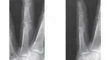 ماجرای مردی که از پزشکان خواست دو انگشتش را قطع کنند