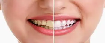 رنگ طبیعی دندان چه رنگی است؟
