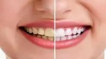 رنگ طبیعی دندان چه رنگی است؟