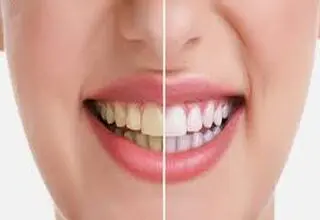با این صیفی جات قرمز، لثه‌های خود را نجات دهید