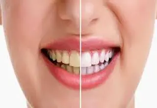 رنگ طبیعی دندان چه رنگی است؟