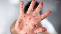 شناسایی ۶۷۴ مبتلا به "سرخک" در کشور