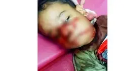 کودک ۴ ساله قربانی حمله سگ‌های ولگرد در خوزستان + عکس