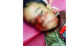 کودک ۴ ساله قربانی حمله سگ‌های ولگرد در خوزستان + عکس