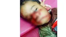 کودک ۴ ساله قربانی حمله سگ‌های ولگرد در خوزستان + عکس