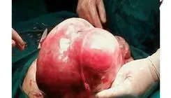  از رحم یک بیمار در اردبیل توده 7 کیلویی خارج شد