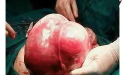  از رحم یک بیمار در اردبیل توده 7 کیلویی خارج شد