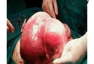  از رحم یک بیمار در اردبیل توده 7 کیلویی خارج شد