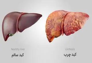 چهار عامل مهم ابتلا به کبد چرب
