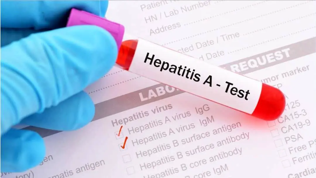 فاجعه بهداشتی پنهان: شیوع هپاتیت A در نوجوانان