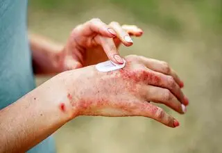 درمان مرحله‌ای اگزما بر اساس شدت بیماری