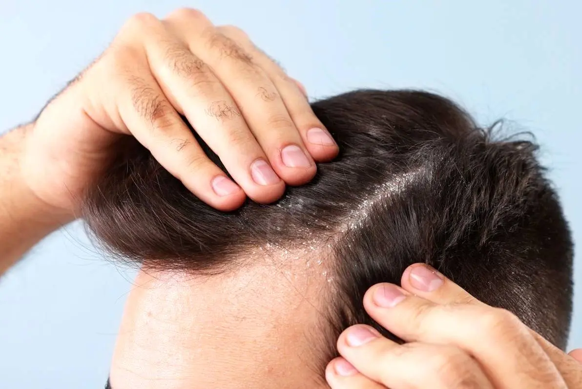 دلیل خشکی مو با وجود چربی کف سر چیست؟