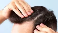 دلیل خشکی مو با وجود چربی کف سر چیست؟