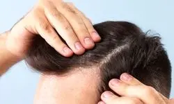 دلیل خشکی مو با وجود چربی کف سر چیست؟