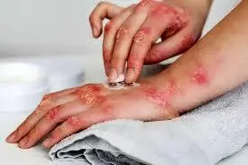 بیماری سلیاک چیست؟