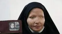 بخشش ضارب اسید پاش پس از ۱۱ سال