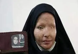 بخشش ضارب اسید پاش پس از ۱۱ سال