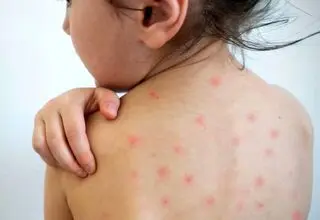 اروپا درگیر موج تازه سرخک