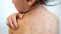 خداحافظ سرخک، خداحافظ سرخجه