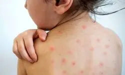 خداحافظ سرخک، خداحافظ سرخجه