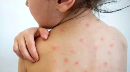 خداحافظ سرخک، خداحافظ سرخجه