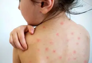 خداحافظ سرخک، خداحافظ سرخجه