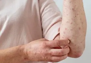 آخرین وضعیت بروز آبله‌مرغان در کشور