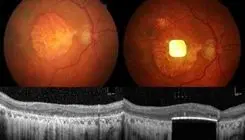 بازگشت بینایی با هوش‌ مصنوعی