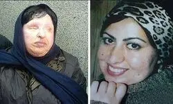 بلاتکلیفی اولین قربای اسیدپاشی در دریافت دیه