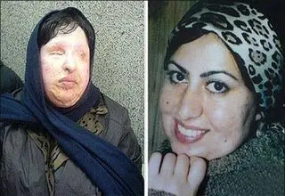 بلاتکلیفی قربانی اسیدپاشی در دریافت دیه پس از 19 سال