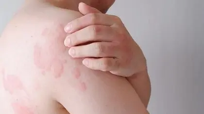 بیماری پروانه‌ای؛ میراث دردناک ژن‌های مشترک