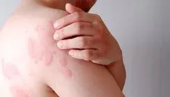 بیماری پروانه‌ای؛ میراث دردناک ژن‌های مشترک