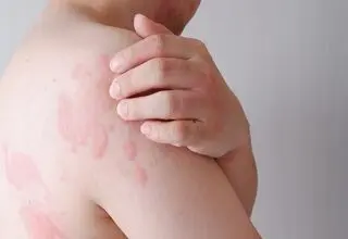 بیماری پروانه‌ای؛ میراث دردناک ژن‌های مشترک