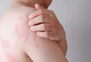 بیماری پروانه‌ای؛ میراث دردناک ژن‌های مشترک