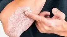 بیماری‌های نادری که موجب مرگ می‌شوند