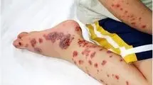 کنه‌ای که جان می‌گیرد