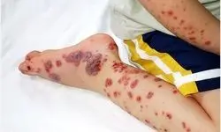  کنه‌ای که جان می‌گیرد