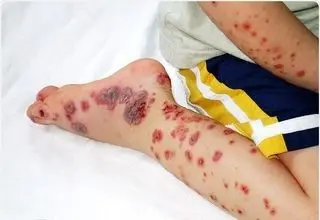  کنه‌ای که جان می‌گیرد