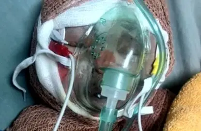 روایت مرگ «رایان» ۲ ماهه و اثر تحریم‌ها بر درمان مجروحان