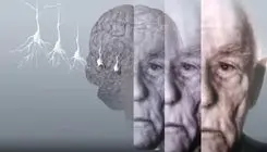 طراحی ابزار هوش مصنوعی برای تشخیص نوع و شدت زوال عقل