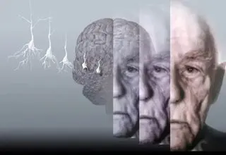 طراحی ابزار هوش مصنوعی برای تشخیص نوع و شدت زوال عقل