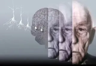 طراحی ابزار هوش مصنوعی برای تشخیص نوع و شدت زوال عقل
