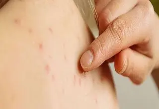 در فصل بهار بیشتر مراقب این بیماری دردناک باشید