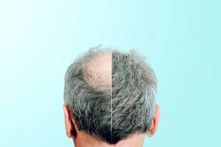 کشف جدید درمان طاسی