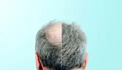 کشف جدید درمان طاسی