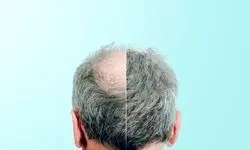 کشف جدید درمان طاسی