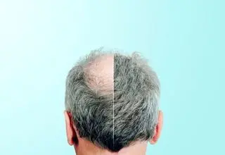 کشف جدید درمان طاسی